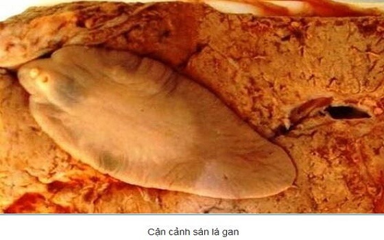 cách chữa bệnh sáng lá gan